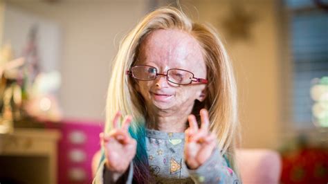 YouTuber Adalia Rose dies aged 15 from genetic condition 